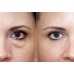 Dermaheal EyeBag Solution 5x1.5ml