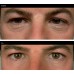 Dermaheal EyeBag Solution 1x1.5ml